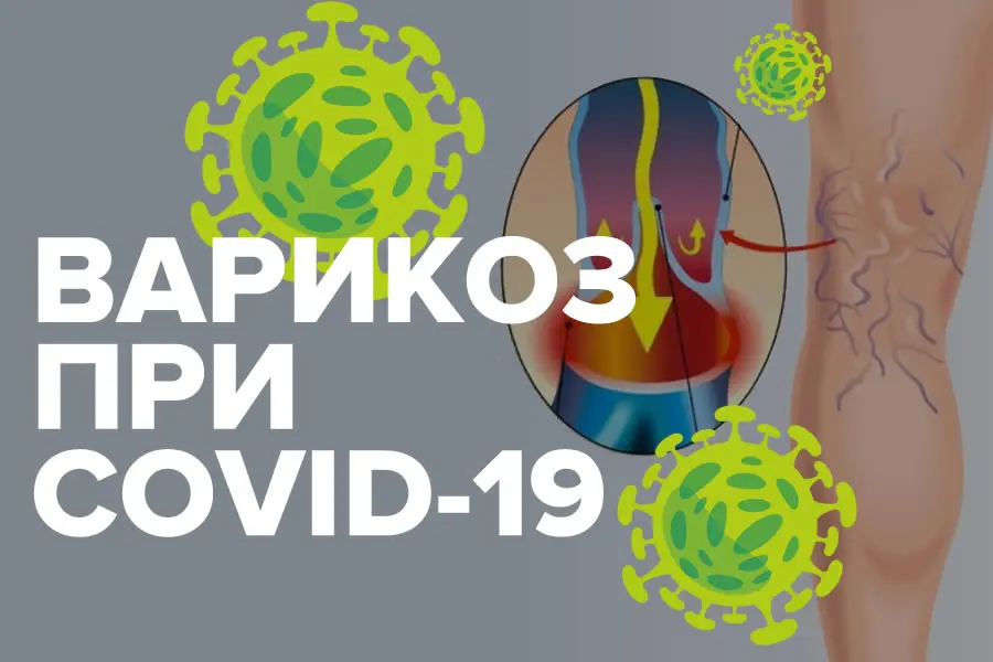 COVID-19 и варикозная болезнь