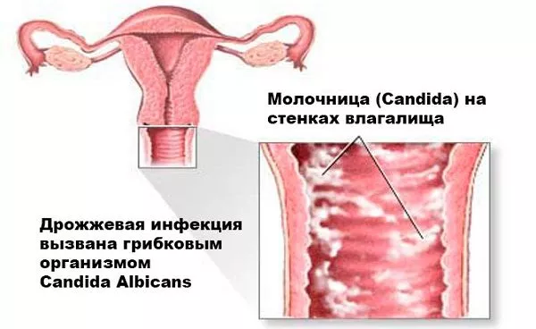 Лечение молочницы у женщин и мужчин