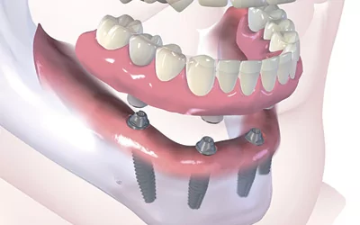 Восстановление всех зуба