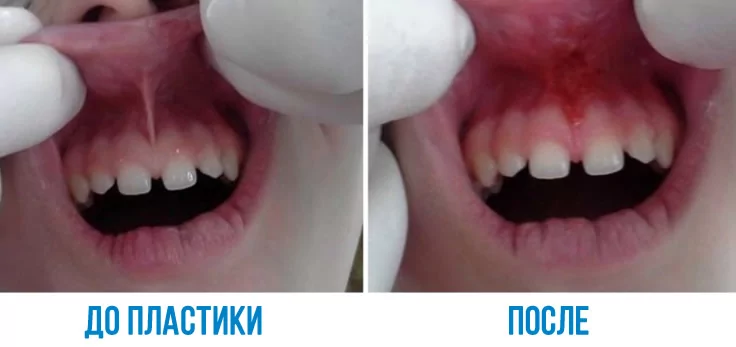 Фото до и после подрезания уздечки верхней губы