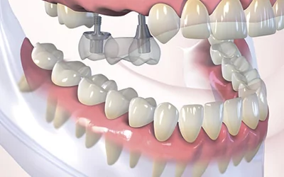 Восстановление нескольких зубов