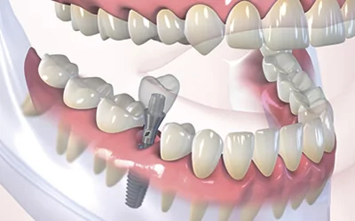 Восстановление одного зуба
