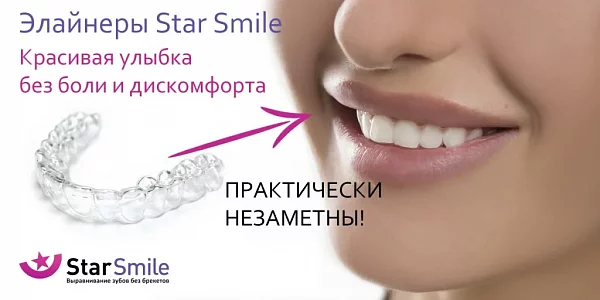 Элайнеры Star Smile: эстетичное решение неправильного прикуса